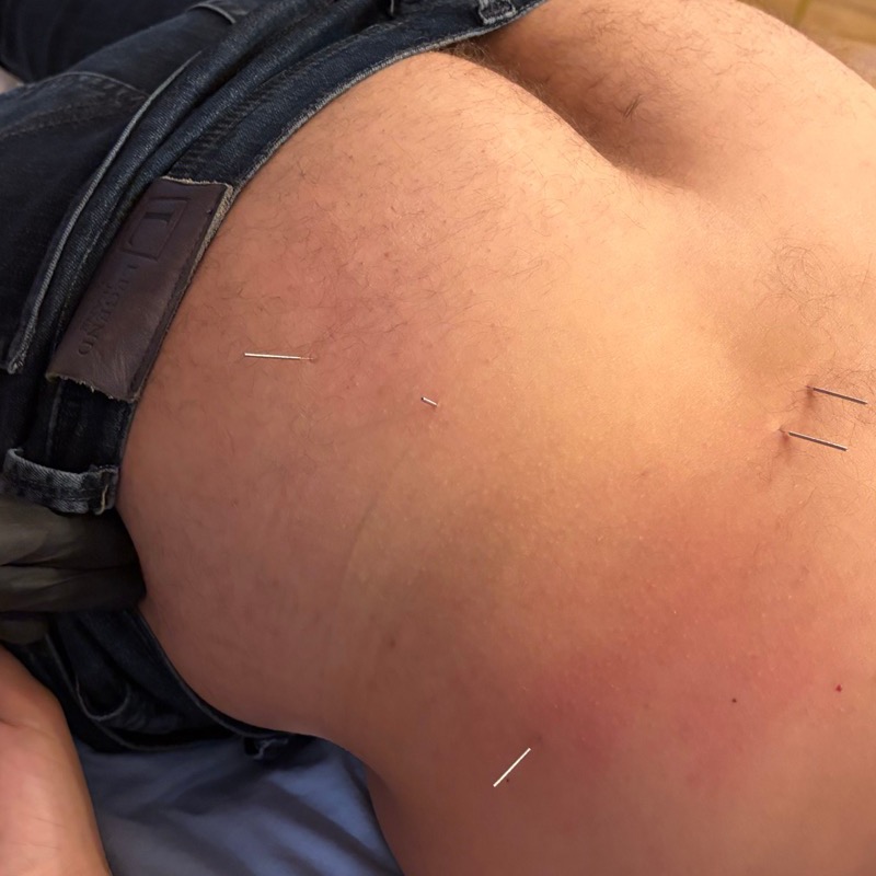Dry needling kod bola u leđima